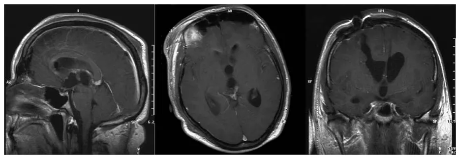 图2 术后早期矢状位、轴位及冠状位对比增强磁共振成像扫描