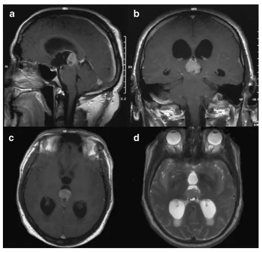 图1 术前矢状位(a)、冠状位(b)及轴位(c)对比增强T1加权磁共振成像；肿瘤在T2加权成像上呈高信号(d)