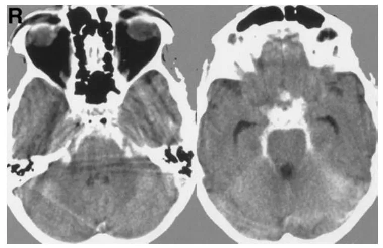 图 1 轴位计算机断层扫描显示基底池蛛网膜下腔出血