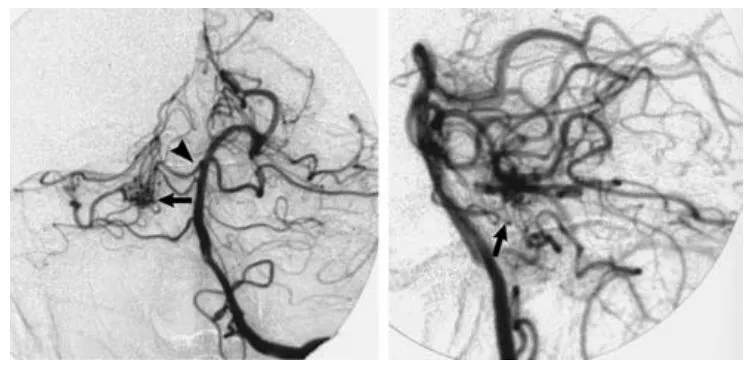 图 2 左侧椎动脉数字减影血管造影正位（左）、侧位（右）像（动脉期），显示畸形血管团（箭头）由双支小脑上动脉（箭头端）供血