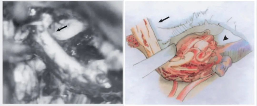 图 3 左：术中照片显示三叉神经根底部（箭头）与动静脉畸形关系密切；右：示意图（山口幸子绘），显示三叉神经近端（箭头）与畸形血管（箭头端）