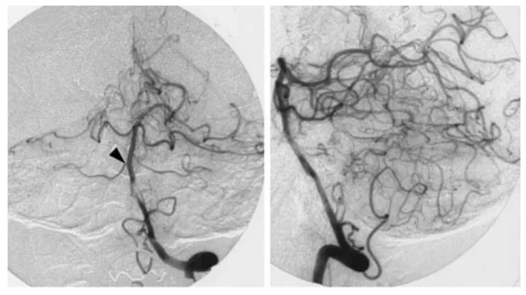 图 4 左侧椎动脉数字减影血管造影正位（左）、侧位（右）像，显示无残余动静脉畸形，仅见 1 支右侧小脑上动脉（箭头端）