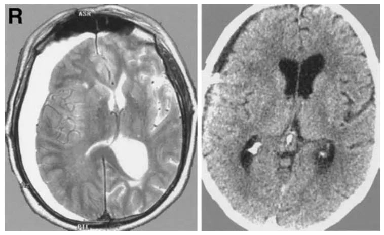图 5 左：轴位 T2 加权磁共振成像显示右侧大脑半球硬膜下水瘤；右：硬膜下 - 腹腔分流术后轴位计算机断层扫描