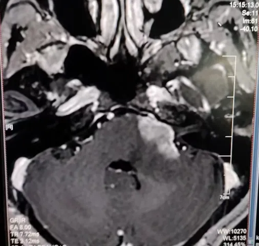 左侧桥臂-小脑半球占位