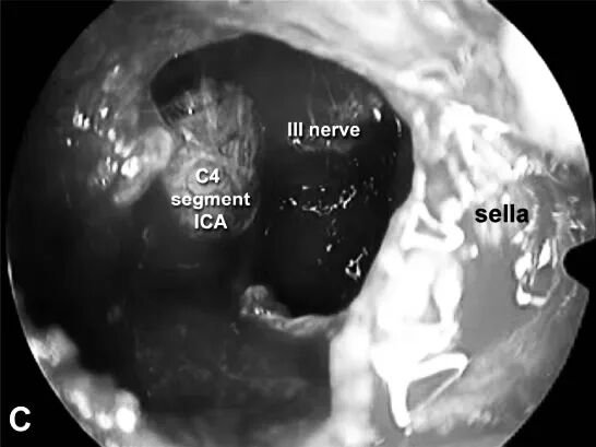 内镜下经内侧三角入路