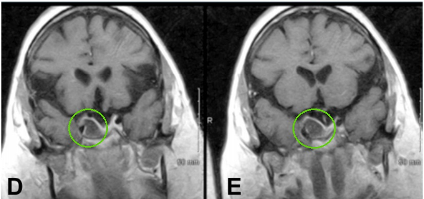 术后MR患者动眼神经麻痹消退，影像学检查术后3年无复发。