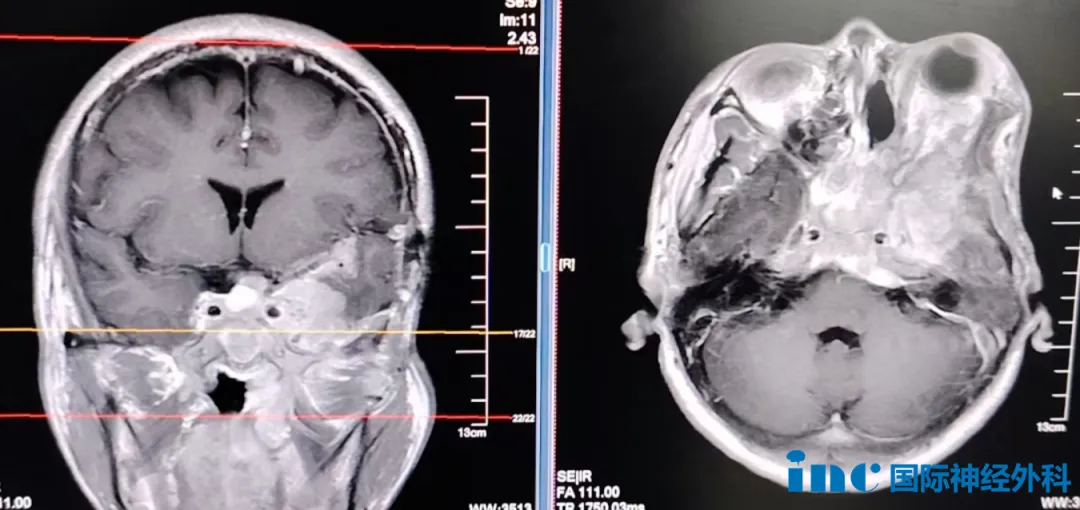 超高难度的颅底脑膜瘤手术