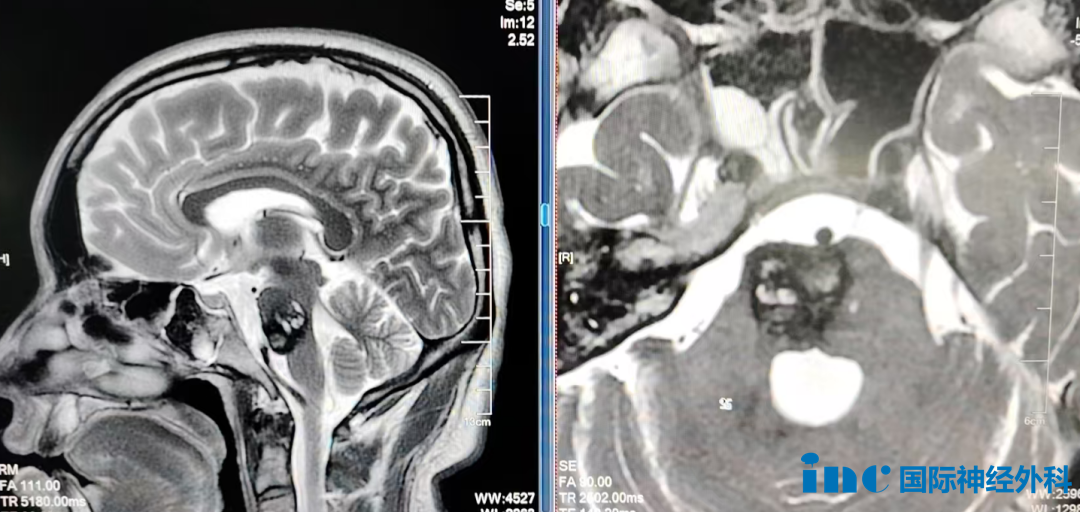 脑干海绵状血管瘤再次出血