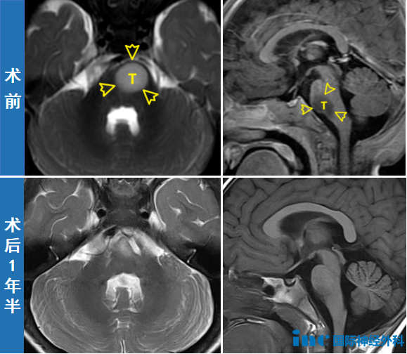 术前术后MRI对比