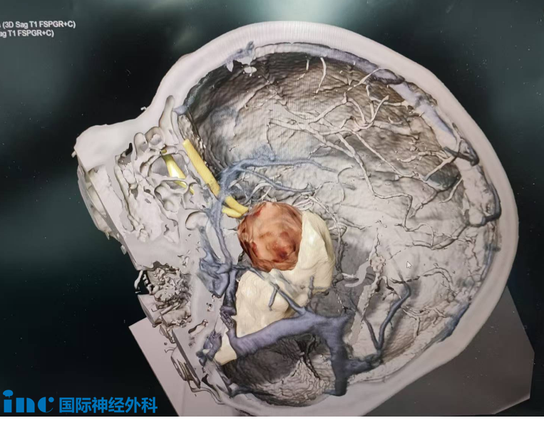 通过影像学 “三维重建”技术