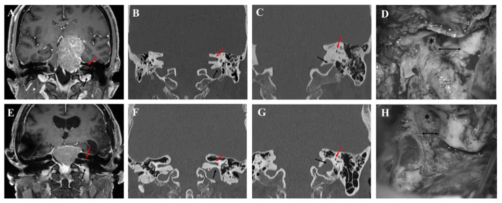 图4. 颈静脉球高度的变异。第一例显示颈静脉球（黑色箭头）与内听道（红色箭头）之间的正常距离（A, B），颈静脉球（黑色箭头）与后半规管（C）之间有足够的空间以暴露迷路下硬脑膜；相反，第二例呈现了一个高位颈静脉球（E–H）。