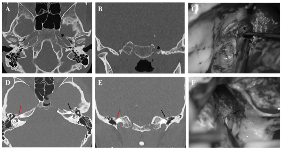 图5. 中颅窝骨质缺损。CT显示左侧岩骨段颈内动脉（*）存在术前骨质缺损（A, B），该患者术中证实了岩骨段颈内动脉上方无骨质覆盖（C）。CT揭示右侧中颅窝底在膝状神经节上方存在骨质缺损（红色箭头），而相应的左侧（黑色箭头）无骨质缺损（D, E）。术中图像证实膝状神经节（黑色箭头）上方无骨质覆盖（F）。