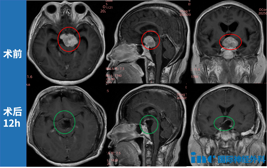 在术中，术者需要以功能保护为核心，精细操作，最终这个肿瘤得到了顺利满意的切除，患者术后恢复良好。