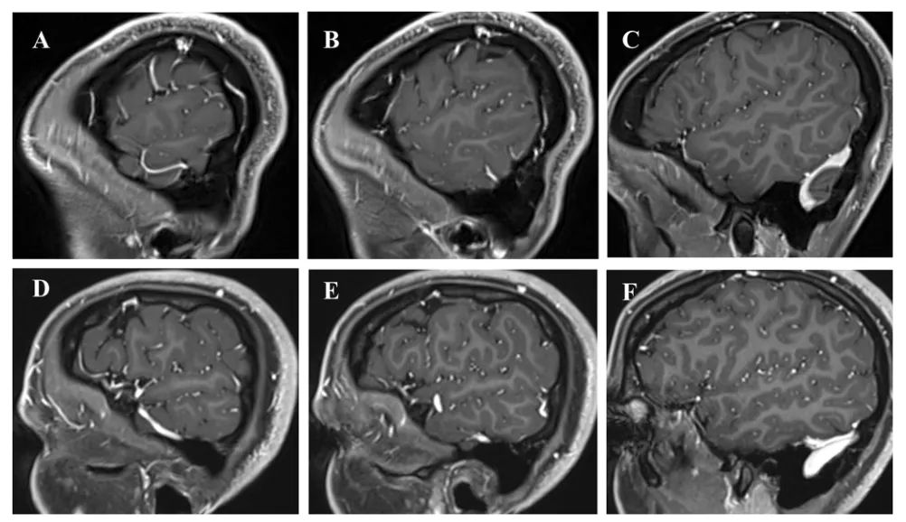 图1.左侧Labbé静脉的两种不同走行模式的矢状位T1增强MRI。从外侧裂到横窦-乙状窦交界处的曲折走行（A–C），以及沿岩骨的较长且低位的水平走行（D–F）。