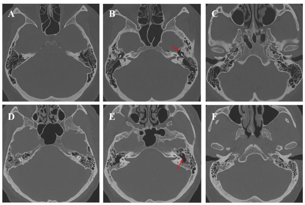 图3. 岩骨气化程度。轴位CT扫描显示两个病例，分别为高度气化（A–C）和低度气化（D–F）的岩骨。在所有病例中，鼓窦入口的存在都是一个恒定结构（红色箭头）。