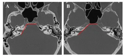 图7. 岩斜角与上半规管突起的变异。轴位CT扫描呈现两种不同的岩斜交界。岩骨与斜坡之间的夹角可在较小（123°，A）到较大钝角（142°，B）之间广泛变化。