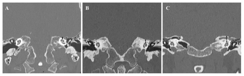 图8. 中颅窝底与耳蜗深度之间的关系。CT显示耳蜗到中颅窝底表面距离的变化。三个不同的病例的距离分别为2.1毫米（A）、4.8毫米（B）和8毫米（C）。