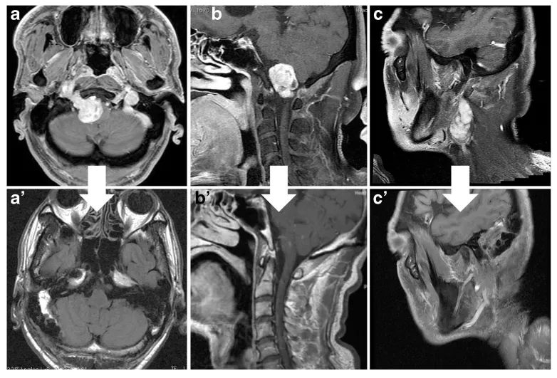 图2:术前(手术前)及术后(手术后1年)磁共振(MR)图像显示肿瘤大体全切除。(A, B, C) 术前轴位及矢状位图像显示肿瘤对延髓造成显著压迫。一副矢状位图像显示肿瘤下极。(A', B', C') 术后图像显示延髓回位至正常位置,证实了肿瘤的完全切除。