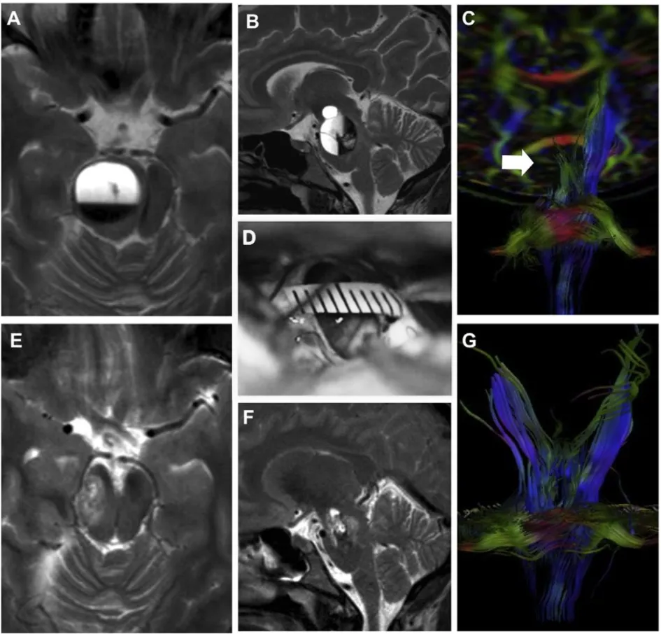妊娠期术前 MRI（A-C）、术中视野（D）及术后 MRI（E-G）。
