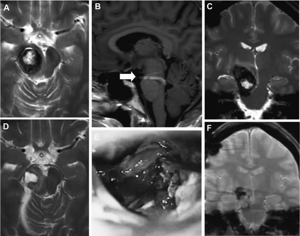 二次手术术前 MRI（A-C）、 术中显微镜视野（E）、术后 MRI（D、F）