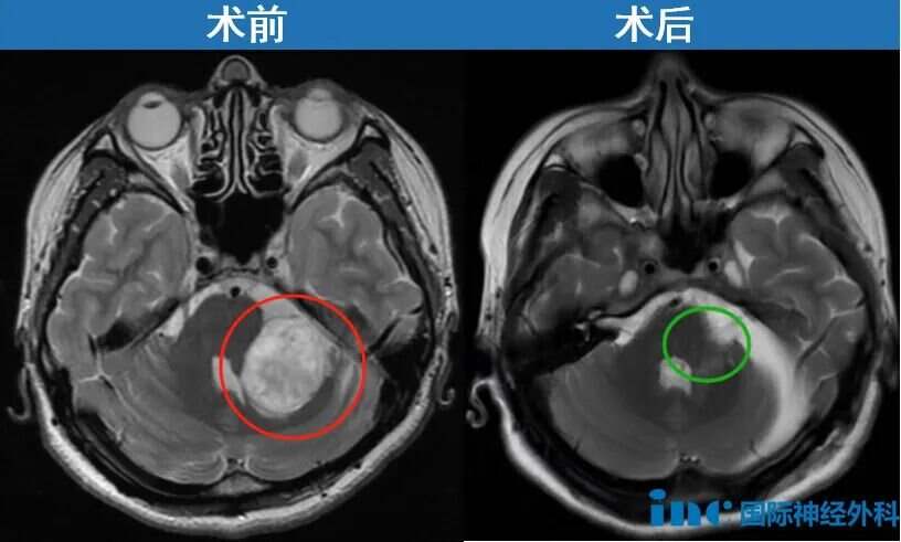 术后4个月随访，巴教授：面神经很好，血管神经都保住了，也没有肿瘤残留。术前脸部严重抽动症状也消失了。