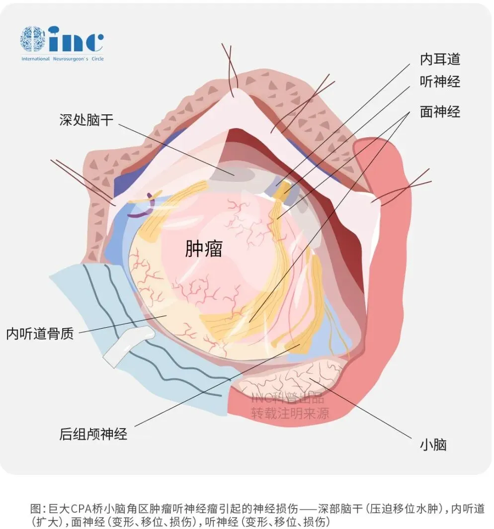 听神经瘤手术的术后并发症有哪些？