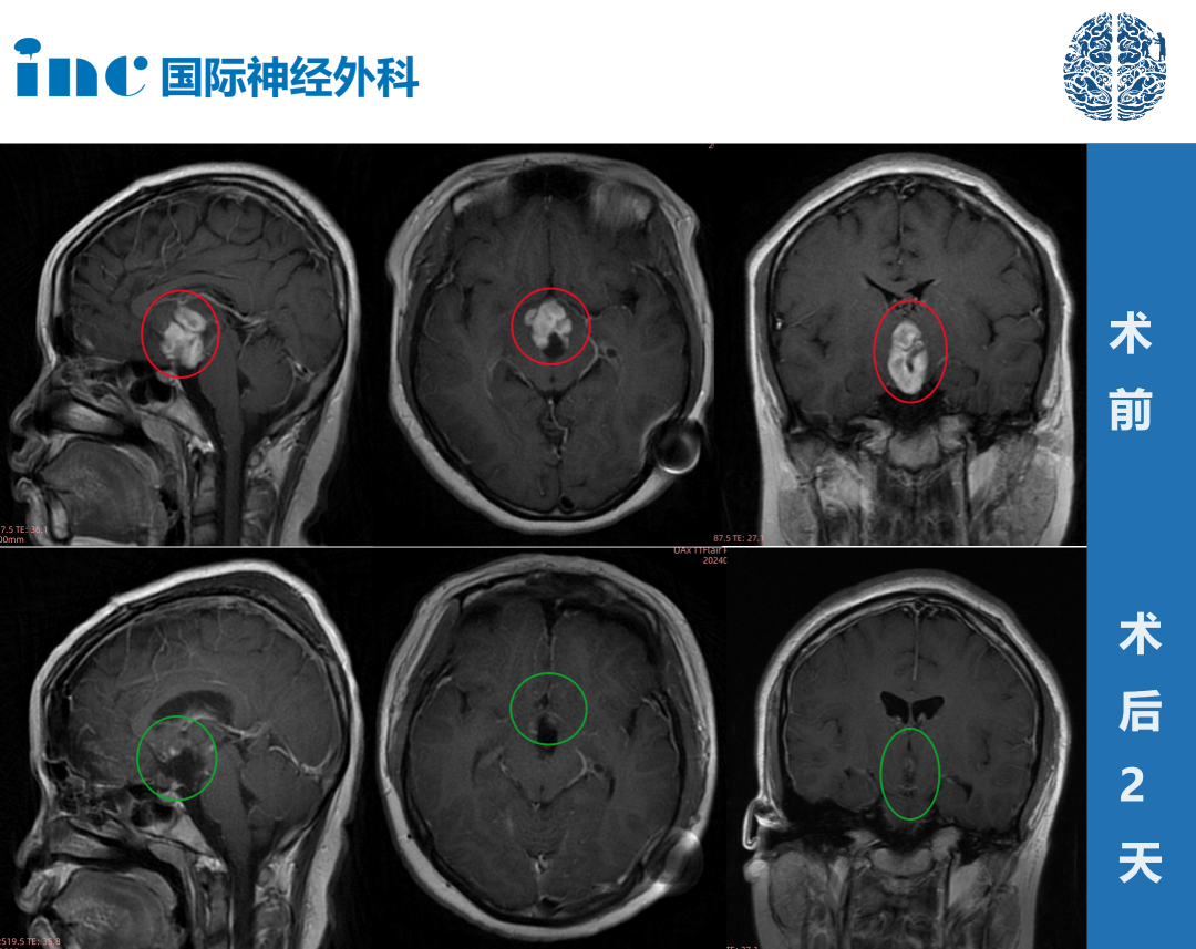 患者术前与术后2天的影像学变化