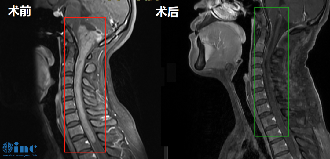 延髓—T1巨大室管膜瘤术后3年无复发