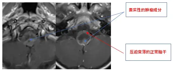 术前MRI