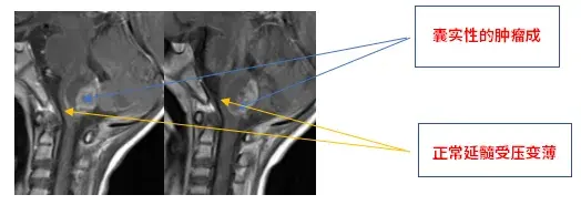 术前MRI
