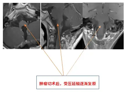 术后MRI 