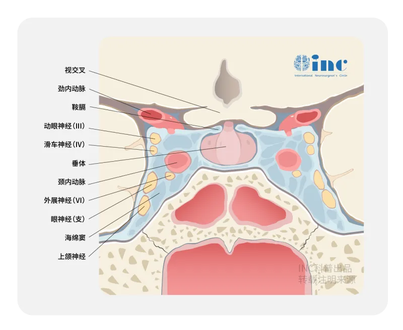 海绵窦肿瘤手术要开颅吗？不一定！研究揭秘成功治疗的另一条路