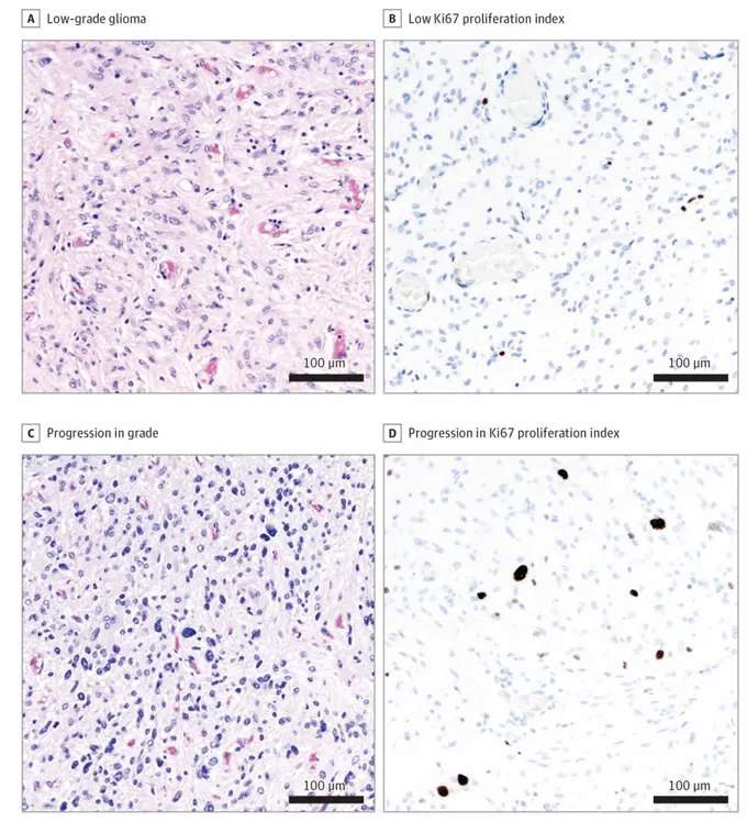 松果体区肿瘤，后经手术切除。最初诊断为低级胶质瘤，Ki67增殖指数低。但下一代测序显示肿瘤在BRAF中发生了H3-3A K27M变异和K601N变异。