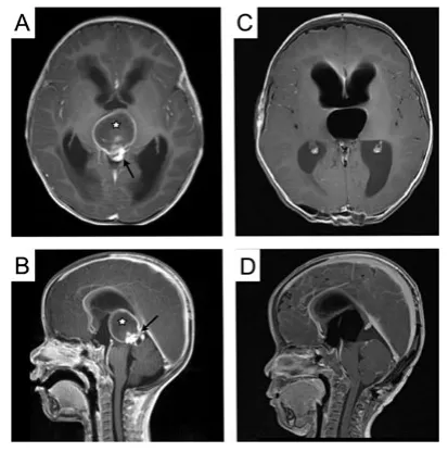 术前和术后MRI。(A,B)术前钆增强T1加权MRI显示一个源自中脑顶盖的低至等信号囊性病变(星号)(箭头)。(C,D)术后MRI显示肿瘤完全切除,无残余对比剂增强。
