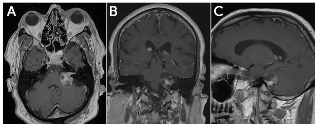 图1： 术前轴位（A）、冠状位（B）及矢状位（C）MRI 显示：约 3 cm 大小、部分囊性、强化明显的病变，使内听道扩大并充填桥小脑角区，符合Koos Ⅳ 级前庭神经鞘瘤表现。