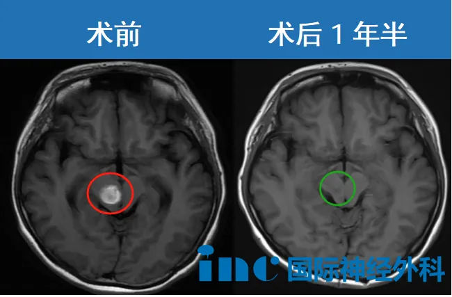 术前术后MRI对比