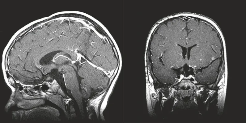 术后MRI