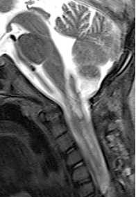 术后MRI