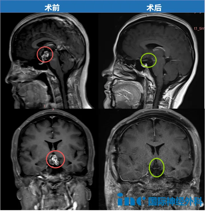 术前术后MRI对比