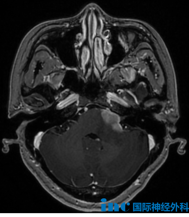 术前MRI