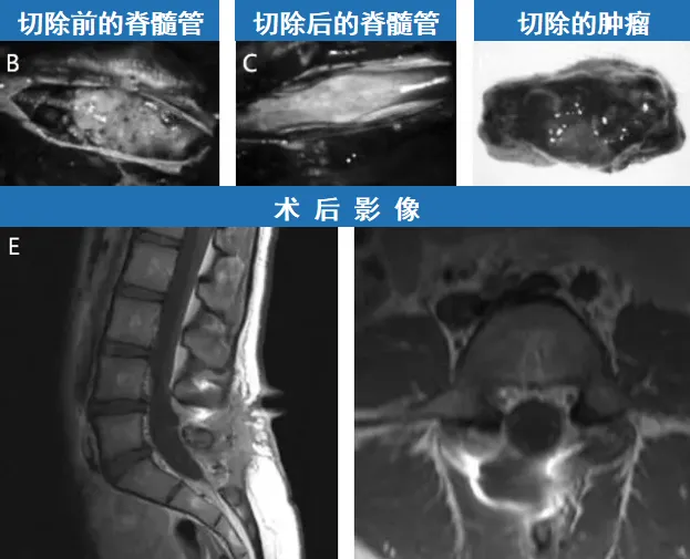 术后，女孩没有任何不良反应，神经功能检查一概正常。