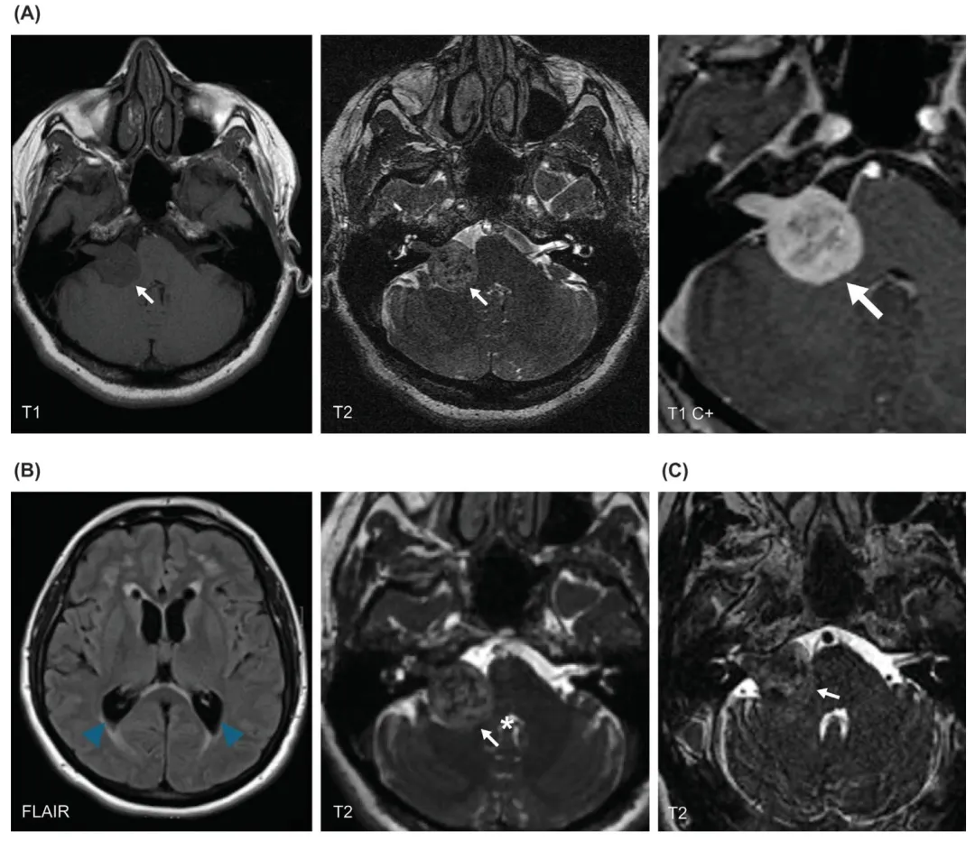 (A) 首次 MRI 可见右侧桥小脑角区病灶(白色箭头),呈 T1 低信号、T2 不均匀高信号,弥漫性强化并延伸至内听道底,占据右侧内听道。 (B) 立体定向放射外科治疗前影像显示病灶体积增大(白色箭头),对脑干产生占位效应,导致第四脑室受压变扁(白色星号),并伴轻度幕上<a href='/naojishui/' target='_blank'><u>脑积水</u></a>(蓝色箭头示侧脑室三角区扩大及周围室管膜下水肿,符合梗阻性脑积水表现)。 (C) 立体定向放射外科治疗后 5 年 MRI 证实肿瘤保持稳定(白色箭头)。