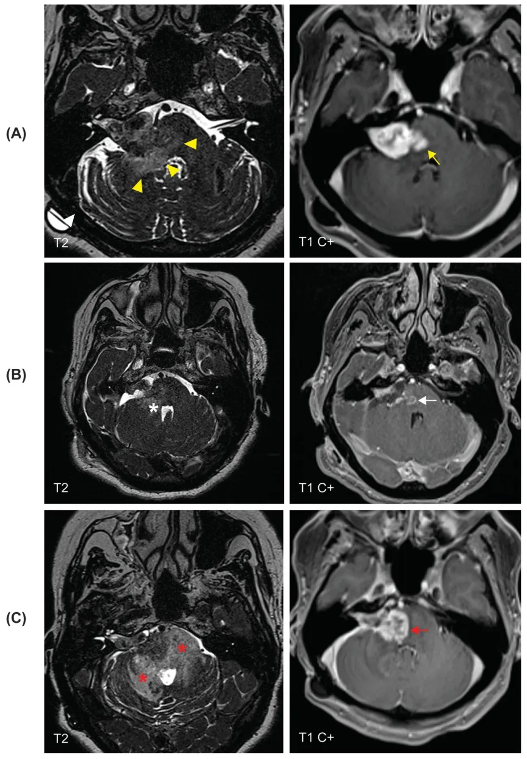 (A) 立体定向放射外科治疗后 6 年 MRI 显示肿瘤形态改变,血管源性水肿加重(黄色箭头),并出现从肿瘤内侧延伸至脑干的新发强化灶(黄色箭头)。 (B) 右侧枕下颅骨切除术后影像证实,右侧脑桥半侧存在残留病灶且呈持续性强化(白色箭头),脑桥臂可见异常信号(白色星号)。 (C) 辅助放疗结束后影像显示,残留病灶体积增大(红色箭头),邻近脑干及脑桥臂的信号异常加重(红色星号),这一表现可能提示治疗相关改变或肿瘤进展。