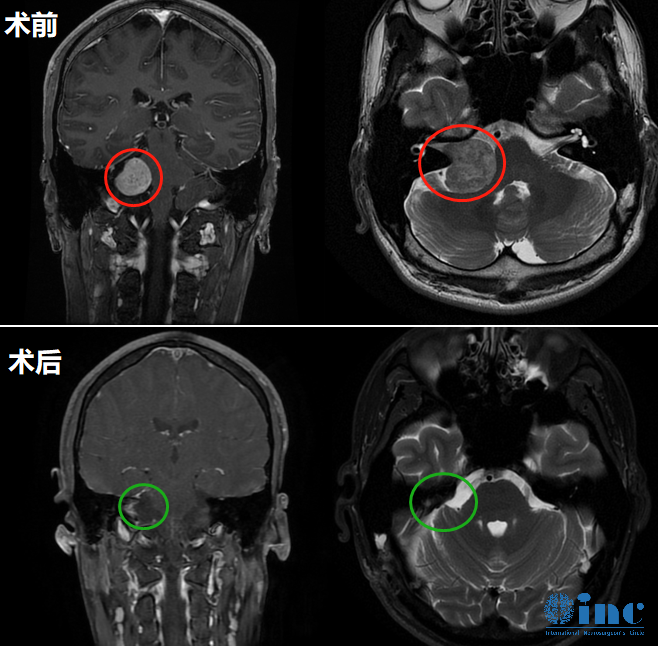 术前术后MRI对比