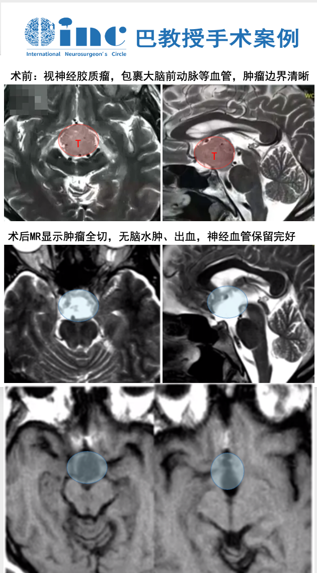 术前:视神经胶质瘤,包裹大脑前动脉等血管,肿瘤边界清晰 术后MR显示肿瘤全切,无脑水肿、出血,神经血管保留完好