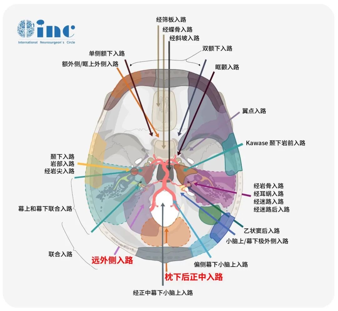 枕骨大孔区脑膜瘤与远外侧入路