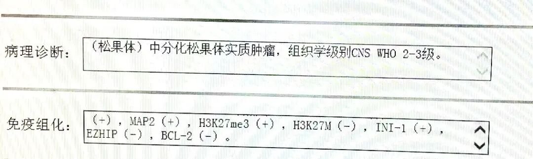 中分化松果体实质肿瘤，WHO2-3级（中度恶性）