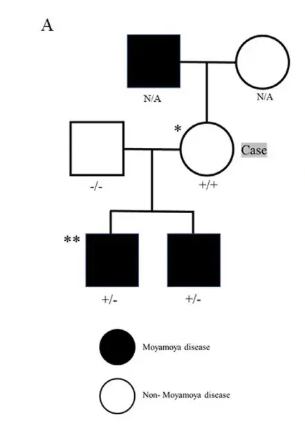 三人基因检测均显示携带RNF213 p.R4810K杂合子变异（图A）