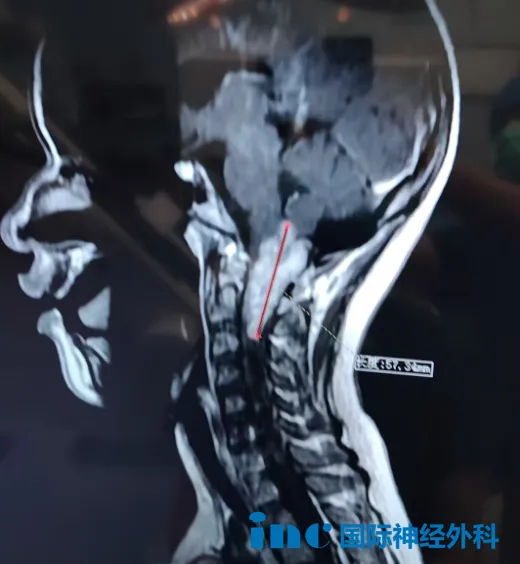 几乎将颈髓压“没”了的巨大延髓-颈髄胶质瘤