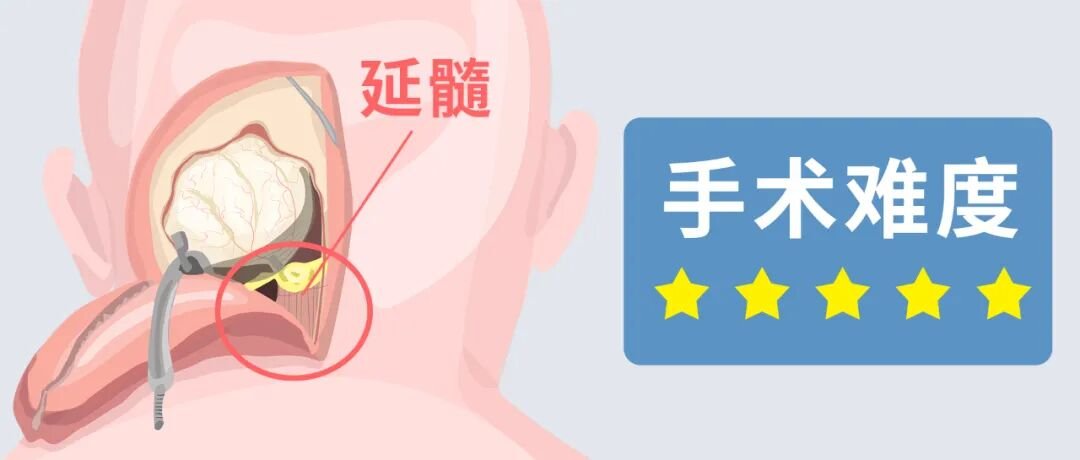 延髓手术难度